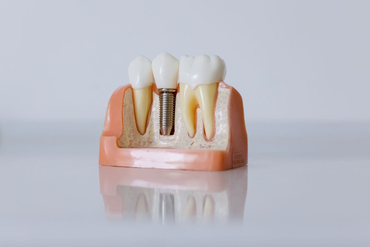 Cross-section dental implant model showing prosthetic crown and bone integration