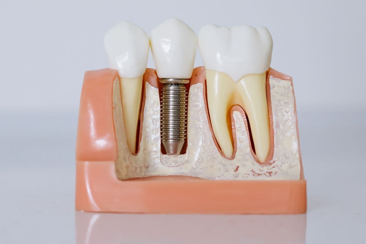 Cross-section model of a screw-retained dental implant crown on an abutment